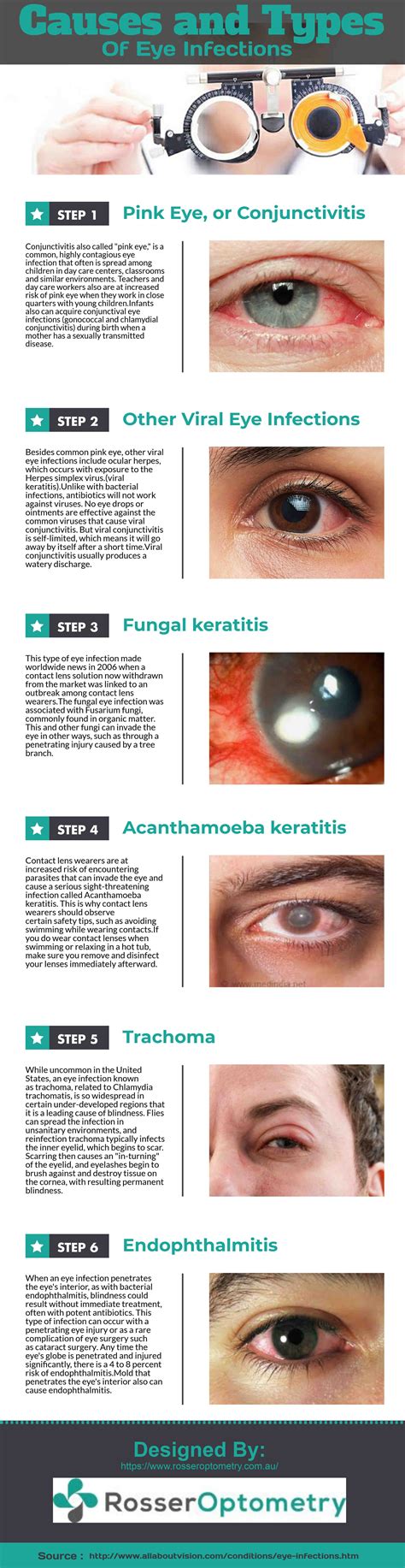 A Closer Look: Various Types of Eye Infections Explored in Dreamscapes