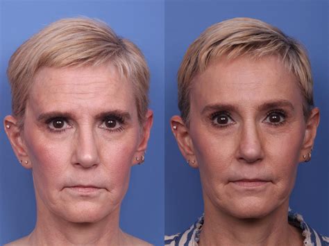 Advances in Surgical Techniques for Facial Reconstruction