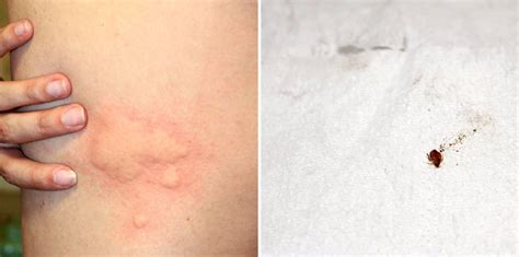 Bed Bug Bites: Beyond mere itchy spots
