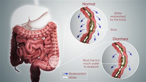Beyond the Symptoms: Understanding the Mechanisms of Diarrhea