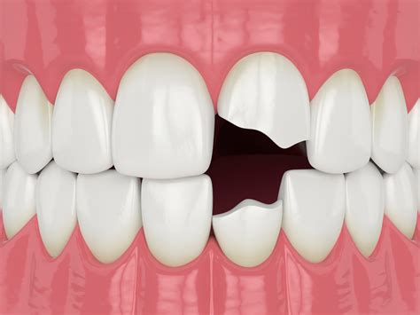 Breaking Teeth: A Symbol of Insecurity and Loss