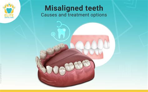 Common Misconceptions about Misaligned Teeth