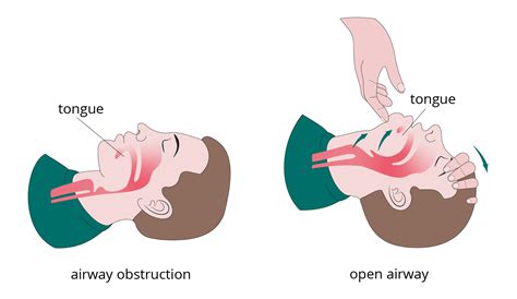 Coping Strategies for Handling Dreams Involving Restricting the Airway of a Serpent