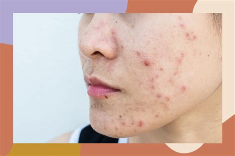 Decoding the Message of Cystic Acne in Your Dreams