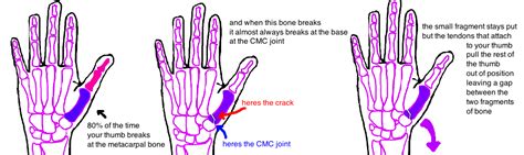 Decoding the Significance of Fractured Thumbs: Insights into Unraveling their Symbolic Messages
