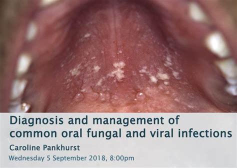 Diagnostics and Detection of Oral Fungal Infections