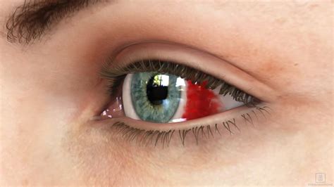 Dive into the Causes: What Triggers Hemorrhaging in the Left Eye during Dreams?