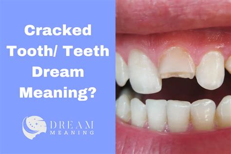 Dreaming of a Cracked Molar: Insights and Significance