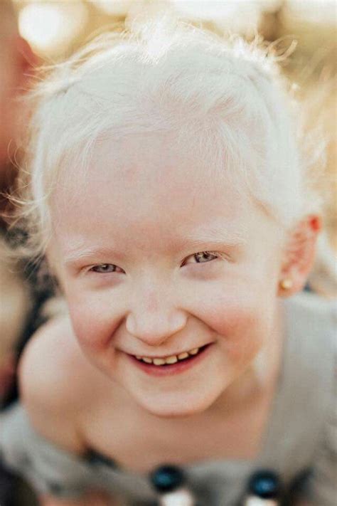 Dreams: Exploring the Enigmatic Insights from the Mind of a Remarkable Albino Child