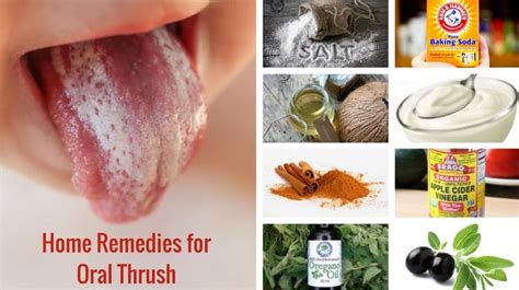 Effective Home Remedies for Treating Oral Fungal Infections