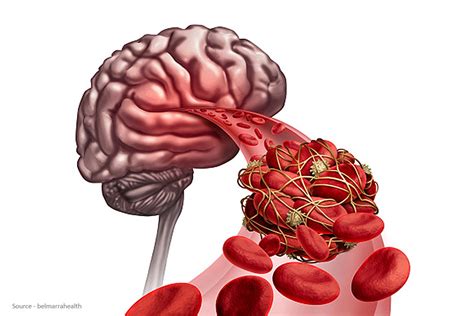 Effects of Brain Blood Clots on Dream Recall