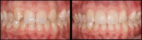 Embracing the Transformational Energy of Piscine Incisors