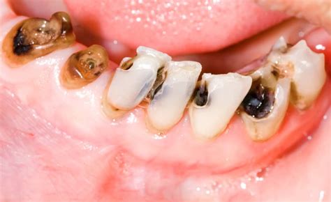Exploring Common Causes of Decayed Teeth Visions
