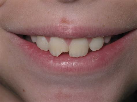 Exploring Dreams about Chip in the Front Teeth: Insights and Analysis