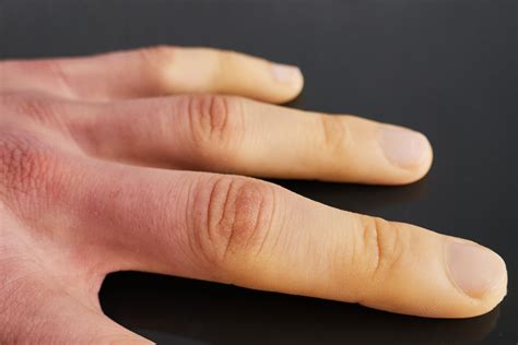 Exploring Physical Health Conditions Associated with Dreams of Discolored Fingers