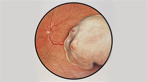 Exploring the Impact of Sleep Patterns on the Development of Ocular Malignancies