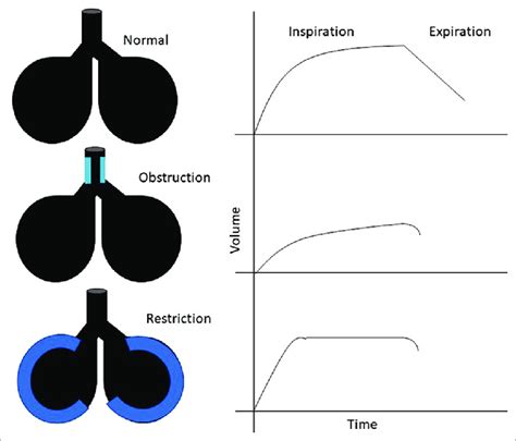 Exploring the Phenomenon of Dreams Involving Obstructed Breathing