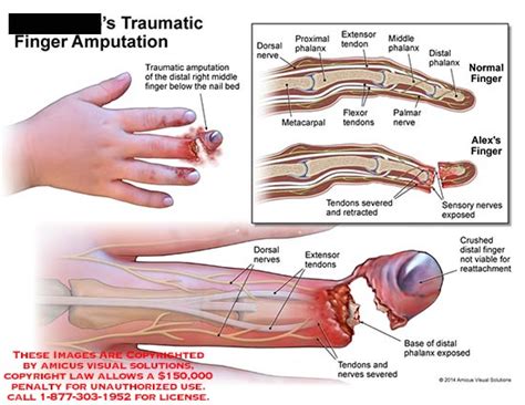 Exploring the Psychological Meanings Behind Dreams Involving Finger Amputations