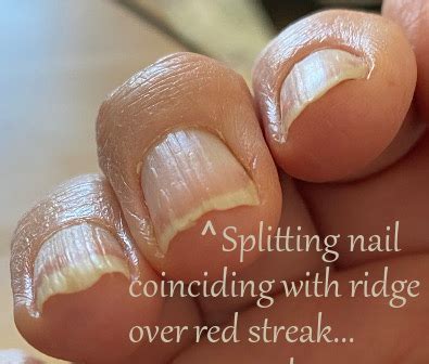 Interpreting dreams about fingernails splitting as a symbol of vulnerability
