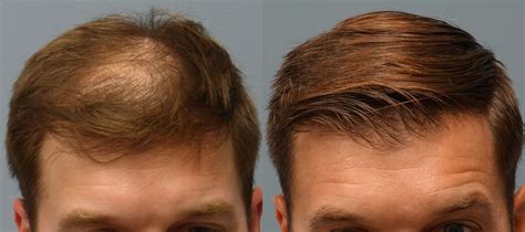 Long-lasting Results: The Enduring Nature of Hair Transplants versus Alternative Solutions