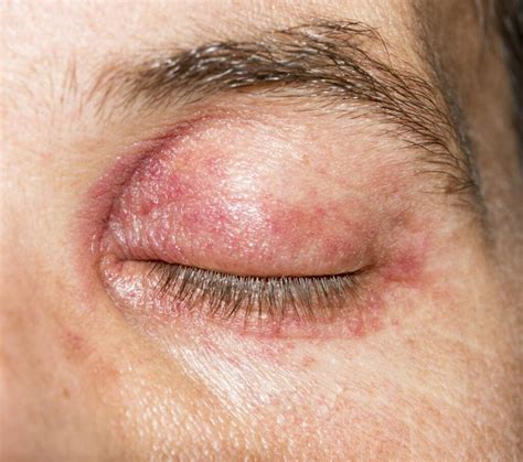 Medical Considerations: Could Bleeding Eyelids be a Symptom of an Underlying Health Issue?
