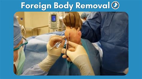 Medical Procedures for Removing Foreign Objects from the Foot: Techniques and Surgical Options