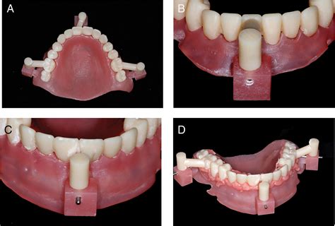 Methods for Analyzing and Decoding Denture Dreams to Foster Personal Growth