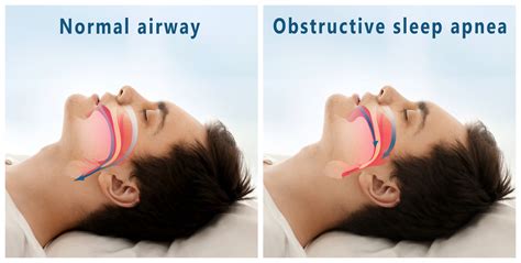 Over-the-Counter Options for Improving Nasal Breathing during Sleep