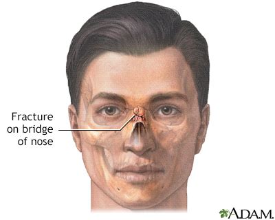 Possible Significance and Explanations of Dreaming about a Fractured Nasal Bridge