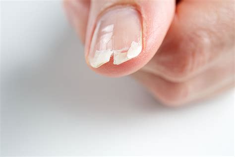 Practical Tips for Decoding and Understanding Dreams of Damaged Fingernails