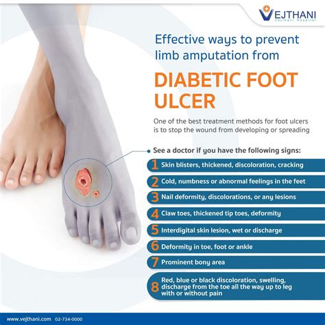 Preventing Leg Ulcers