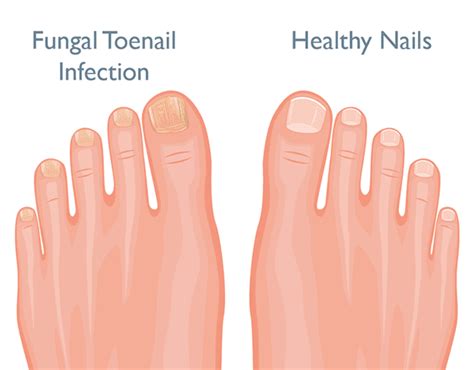Say Farewell to Fungal Infections: Maintaining Healthy Toenails