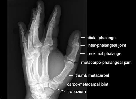 Significance of dreams involving fracture of thumb