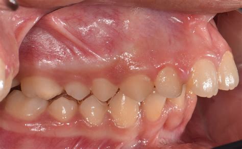 Superstitions and Legends Surrounding Prominent Dental Protrusions