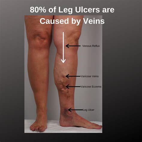 Symptoms of Leg Ulcers