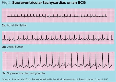The Cryptic Significance of Infant Cardiac Rhythm