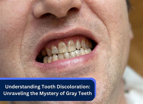 The Curious Case of Teeth That Stick Out: Unraveling the Mystery