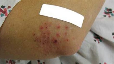 The Enigma of the Mysterious Skin Infections