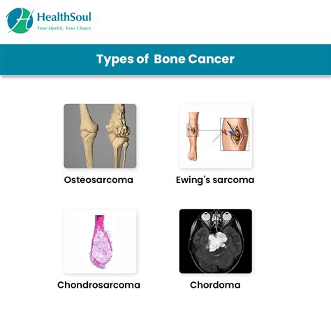 The Fundamentals of Bone Cancer: Varieties, Causes, and Risk Factors