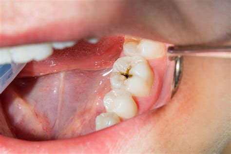 The Hidden Culprits: Common Causes of Damaged Molars