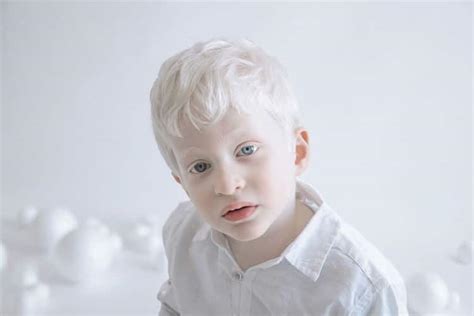 The Impact of Dreams Involving Individuals with Albinism on a Child's Emotional Well-being