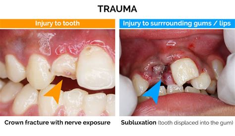 The Influence of Traumatic Dental Experiences on Dream Content