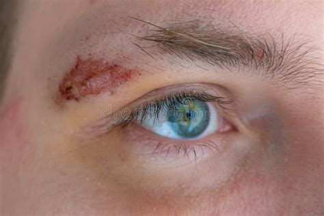 The Intriguing Symbolism of a Wounded Brow