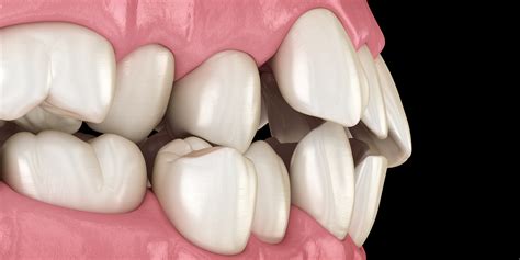 The Intriguing World of Misaligned Dentition