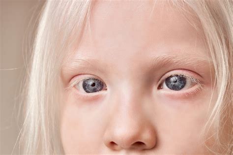 The Power of Color: Understanding the Influence of Albino Vision on Dream Interpretation