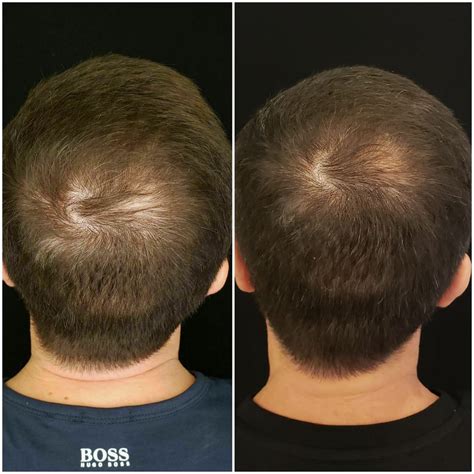 The Progression of Hair Restoration: An Effective Solution for Hair Loss