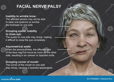 The Psychological Interpretation of Dreams Involving Facial Paralysis