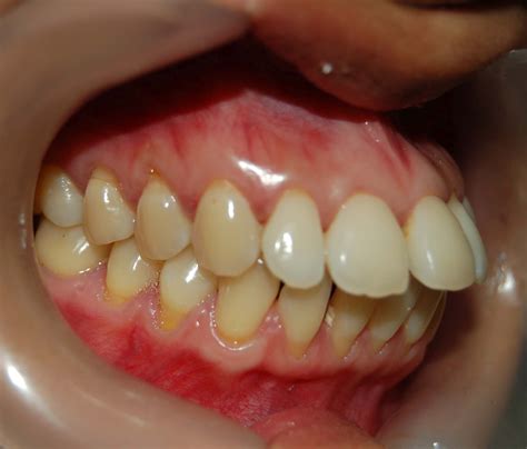 The Significance and Spiritual Significations of Prominent Dental Protrusions