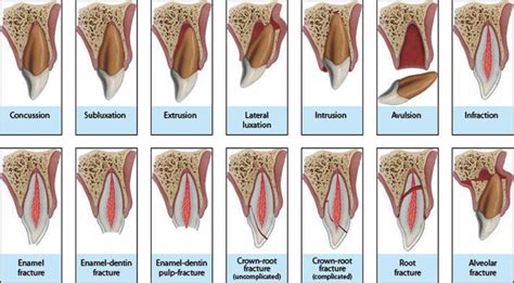 The Significance of Fractured Dentition in Diverse Societies