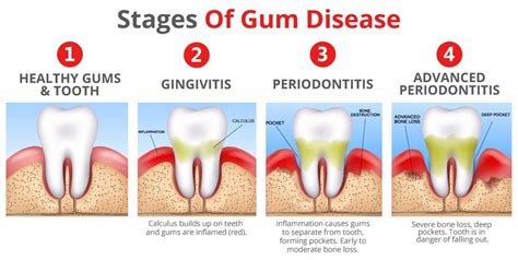 The Significance of Gum Being Lodged in Your Oral Cavity